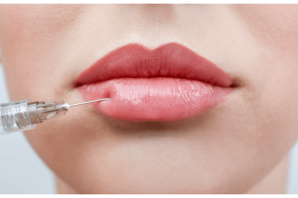 belotero filler types - lip injection