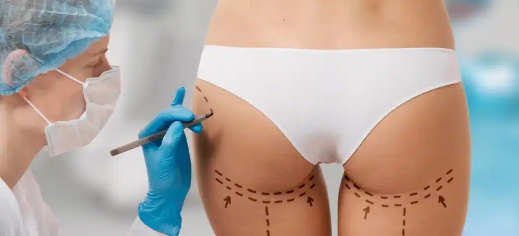 medical professionals marking buttocks for Sculptra enhancement