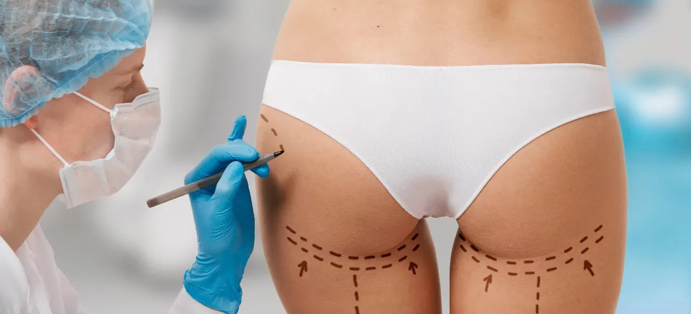 medical professionals marking buttocks for Sculptra enhancement