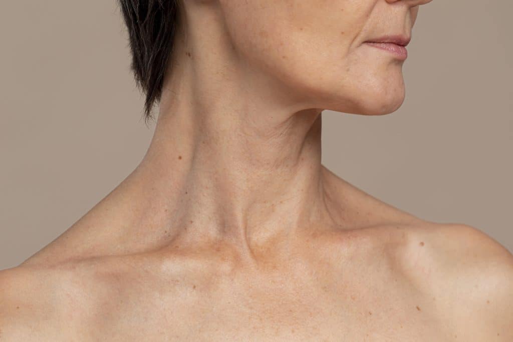 sculptra for sagging neck